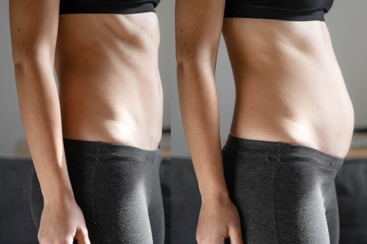 How long does diastasis recti take to improve St Johns?