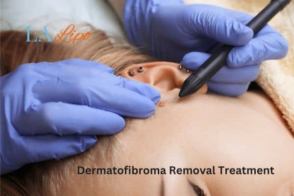 Dermatofibroma Removal Treatment St Johns