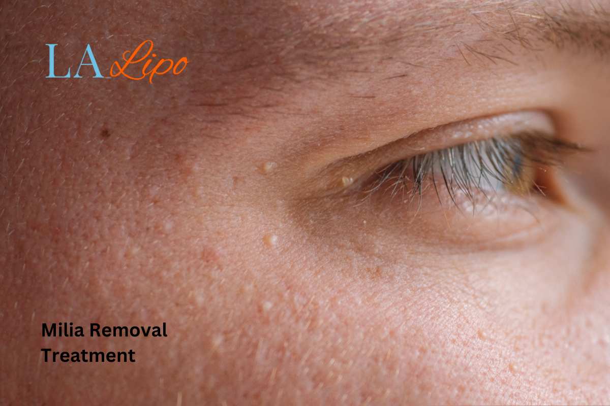 Cryopen Milia Removal: Is It the Easiest and Safest Option St Johns?