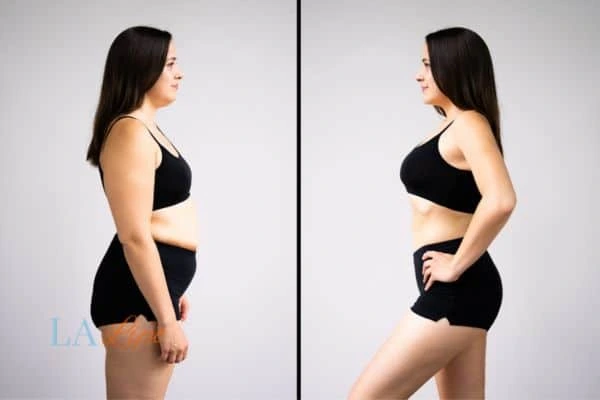 image of woman before and after results of LA-EMS Body Sculpting St Johns to help treat Diastasis recti