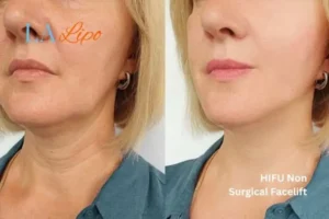hi-fu for wrinkles St Johns before and after results