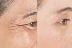Before and after results of woman - HI-fu wrinkles reduction treatment St Johns