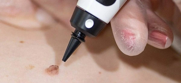 skin tag removal using cryopen St Johns