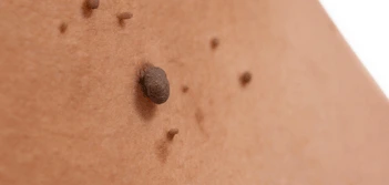 image of a skin tag St Johns