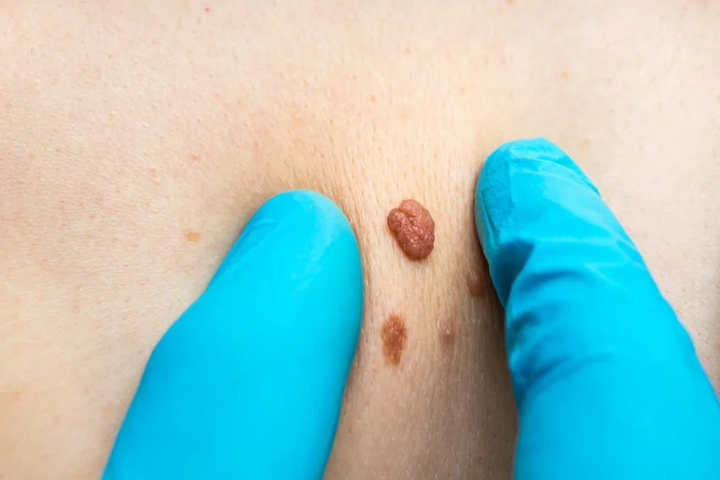 Consultant examining a skin tag St Johns