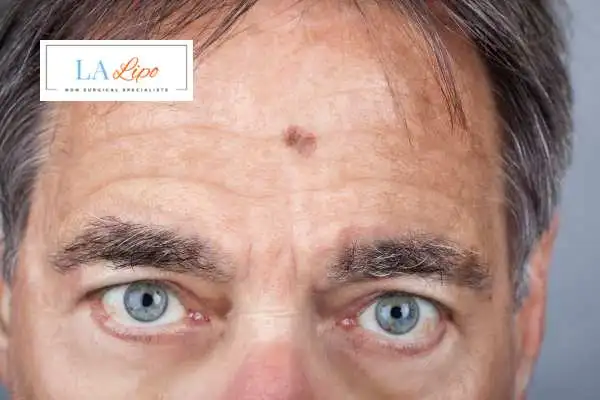 Solar Lentigo Removal St Johns image of man with mark on his forehead