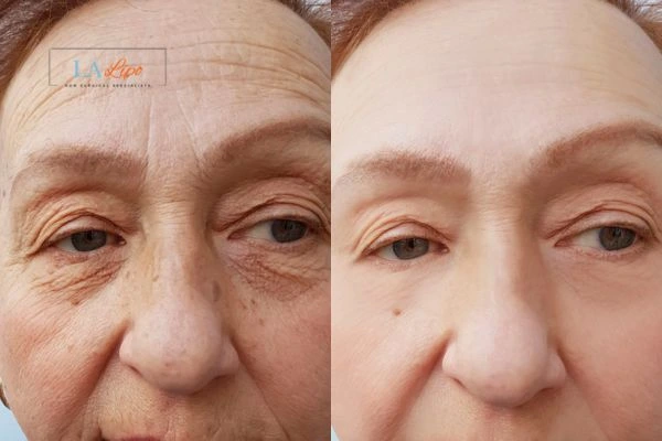 The powerful benefits of Morpheus8 Treatment St Johns - Call Our team today!