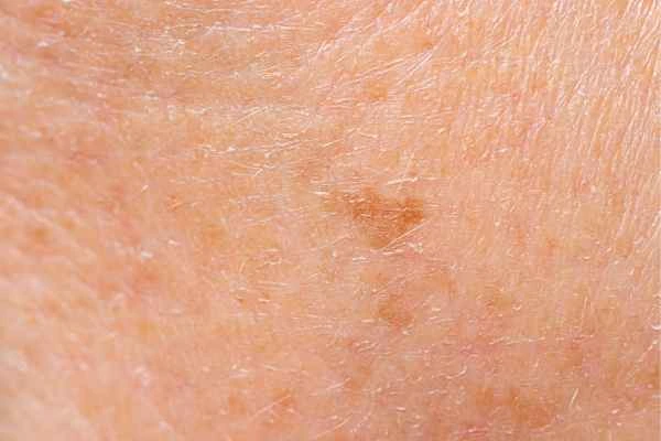 close up picture of age spots St Johns